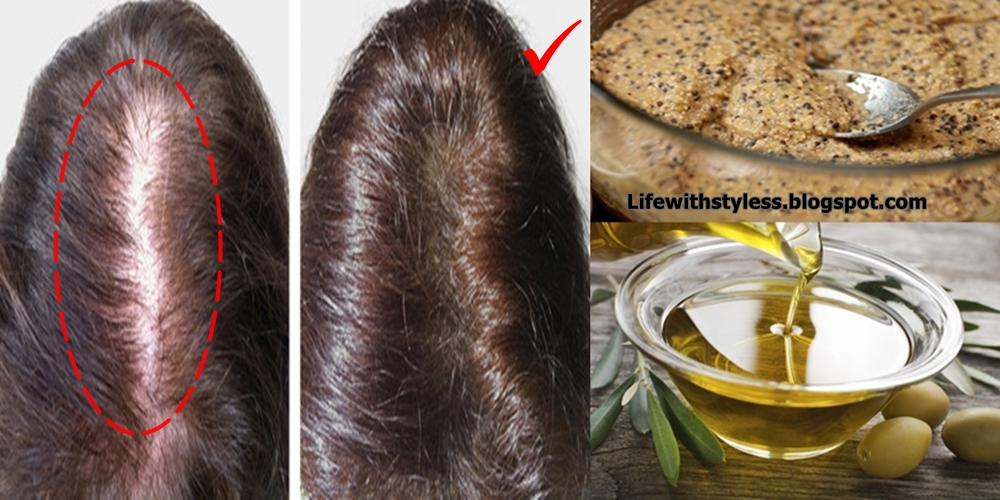 BALDNESS TREATMENT RECIPE AFTER TWO DAYS YOUR HAIR WILL BEGIN TO GROW