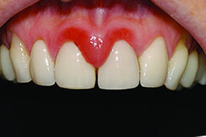 Điều trị nhiễm trùng nướu răng