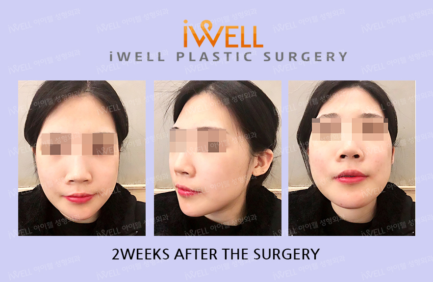 [Real Review] Success the Face contouring surgery in Korea iWELL plastic surgery