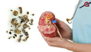 Image nama obat untuk penderita batu ginjal paling manjur