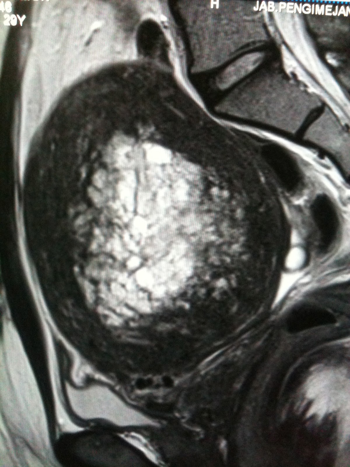 Cystic Endometrial Hyperplasia Ultrasound cystic-endometrial-hyperplasia-ultrasound