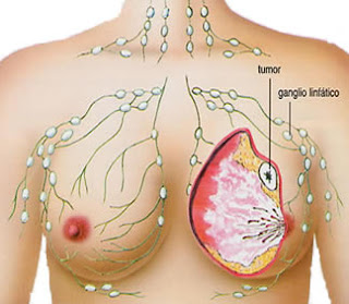 Pengobatan Herbal Mujarab Penyakit Kanker, obat ampuh untuk kanker, pengobatan ampuh untuk kanker