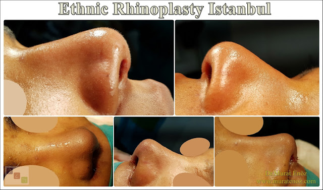Ethnic Rhinoplasty Istanbul – Dr.Murat Enoz – Nose job in Istanbul – Nose surgery in Istanbul – Nose job in Turkey - Ethnic rhinoplasty Turkey - Ethnic rhinoplasty in Turkey - African American rhinoplasty - Ethnic expert nose job surgeon - Rhinoplasty surgeon in Istanbul - Black nose job - Rhinoplasty for ethnic nose - Rhinoplasty for African people - African American nose surgery – Rhinoplasty for African American Nose - Thick skin rhinoplasty - Rhinoplasty in istanbul Ethnic Rhinoplasty Istanbul – Dr.Murat Enoz – Nose job in Istanbul – Nose surgery in Istanbul – Nose job in Turkey - Ethnic rhinoplasty Turkey - Ethnic rhinoplasty in Turkey - African American rhinoplasty - Ethnic expert nose job surgeon - Rhinoplasty surgeon in Istanbul - Black nose job - Rhinoplasty for ethnic nose - Rhinoplasty for African people - African American nose surgery – Rhinoplasty for African American Nose - Thick skin rhinoplasty - Rhinoplasty in istanbul