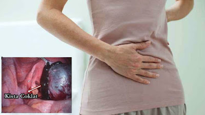 Pengobatan Kista Coklat Secara Herbal Tanpa Operasi