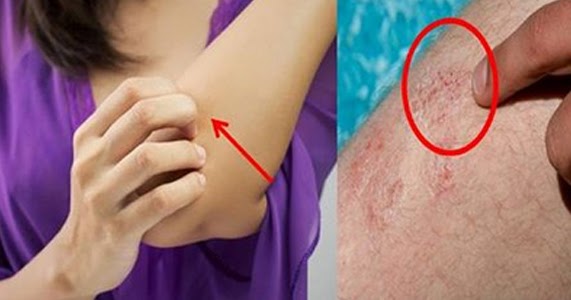 Apakah Anda Sering Merasa Gatal di Siku,Punggung dan Kulit Kepala