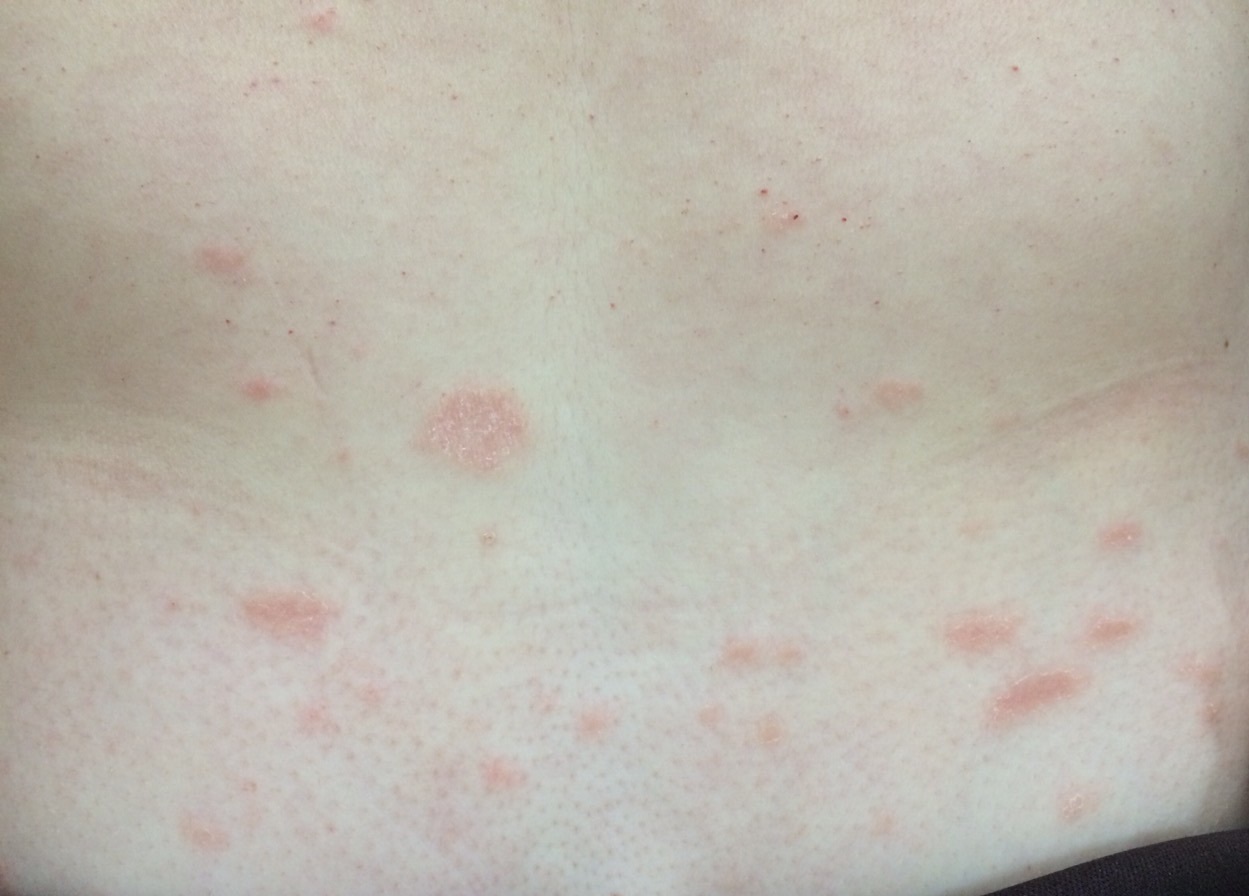 amoxicilina y accutane