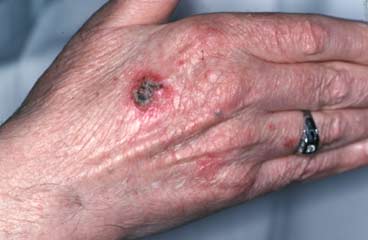 Skin Cancer Symptoms: Pictures of Skin Cancer and ...