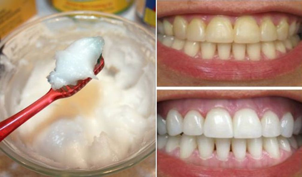 Gargle With One Simple Ingredient And See What Happens To Your Teeth