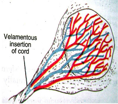 Battledore Placenta - Definition, Complications, Pictures, Causes, Pathology