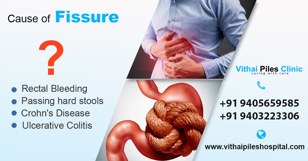 Anal Fissure Causes Symptoms And Treatments Vithai Piles Clinic
