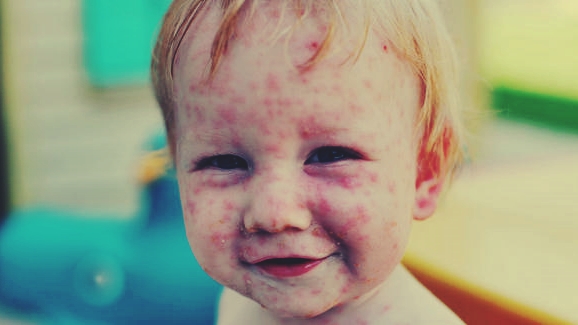 How to Treat Chicken Pox in Children Quickly How to Treat Chicken Pox in Children Quickly