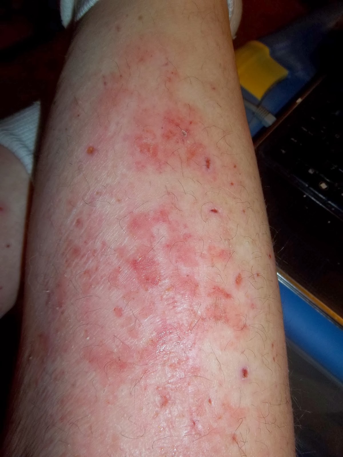 shaving leg lower legs steroids redness arms topical scratch stopping right worse bad hairy inside dickens actually bit looks did