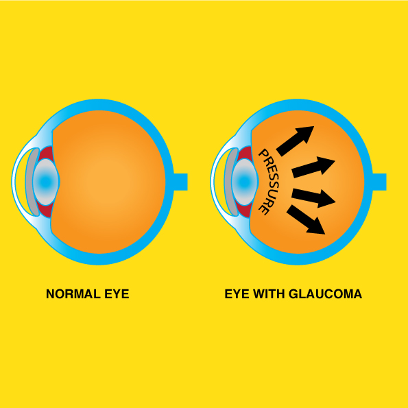 лазерная хирургия глаза. глаз человека. тетаническая катаракта. желтые глаза. глаз человека.
