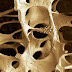 Menopoz ve Osteoporoz (kemik erimesi)