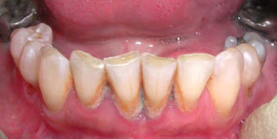 Calculus bridge Images, Symptoms, Causes, Removal Calculus bridge Images, Symptoms, Causes, Removal