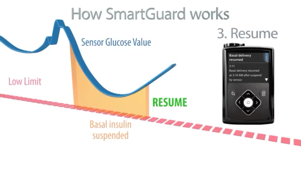 Medtronic Artificial Pancreas >> Medtronic MiniMed 640G and SmartGuard Technology | Ninjabetic Medtronic Artificial Pancreas >> Medtronic MiniMed 640G and SmartGuard Technology | Ninjabetic