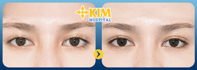  Tại KIM Hospital, bấm mí mắt được thực hiện rất an toàn.