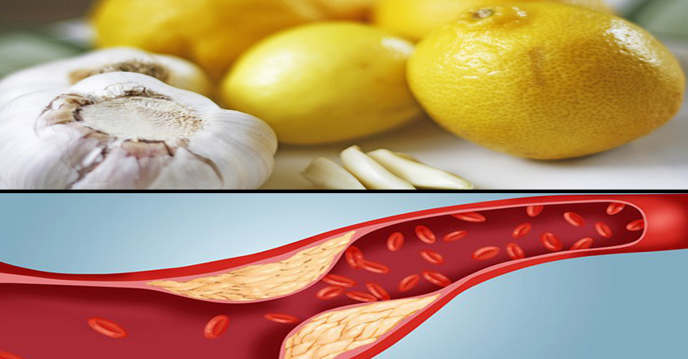 How to Clean Cholesterol Residue From Blood Vessels In 40 day BD