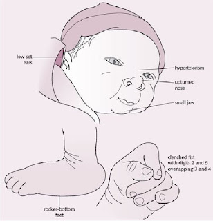 bentuk muka bayi edward syndrome
