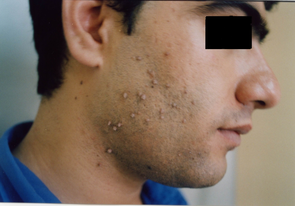 How To Remove Warts On Face Moles, Warts & Skin Tags Removal