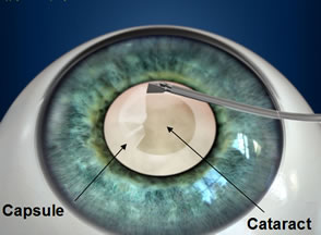 How To Choose The Best IOL For Your Cataract Surgery