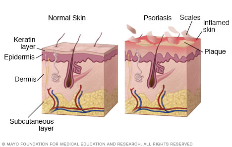 Psoriasis Psoriasis