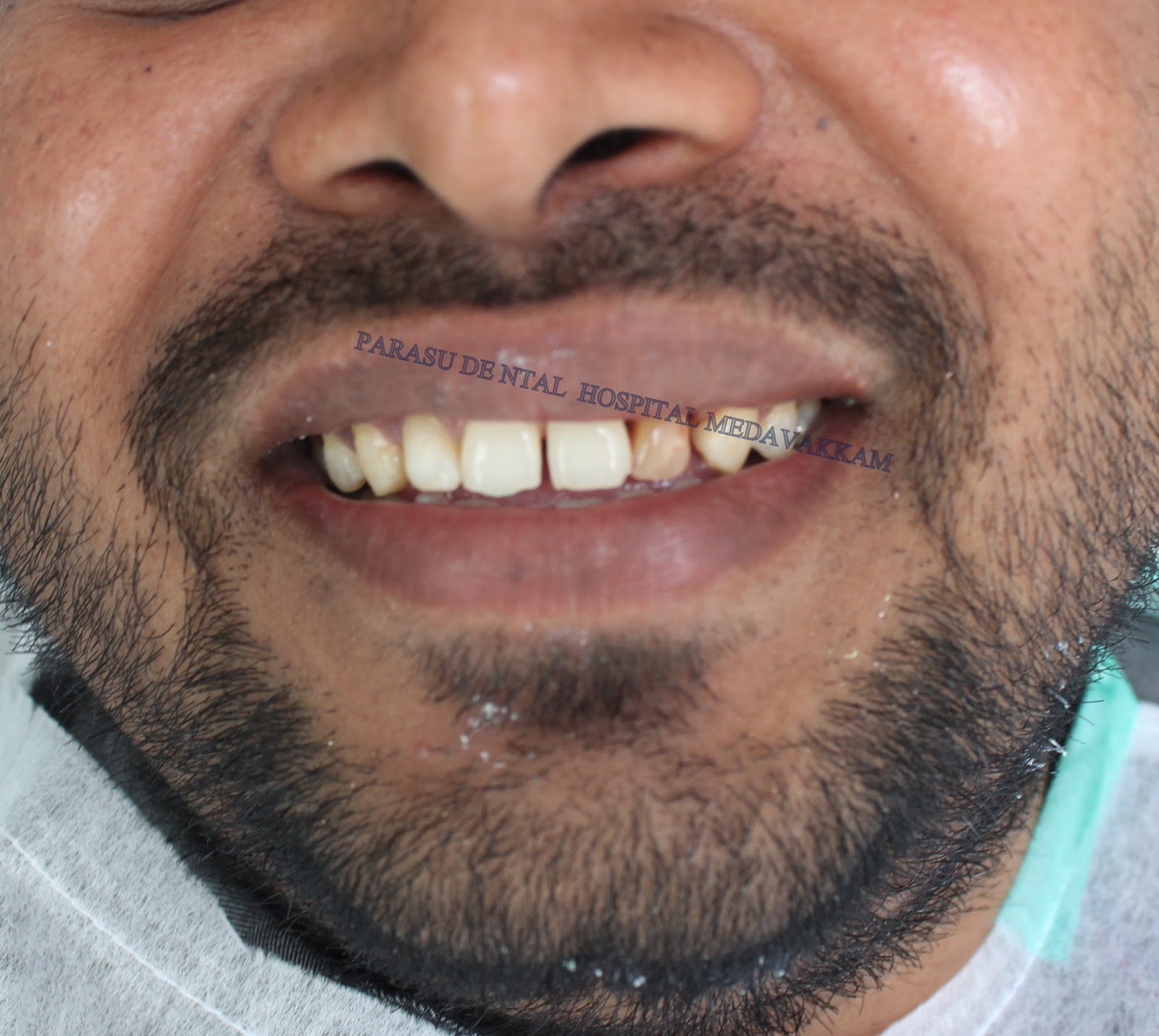 dental implants cost in chennai,India Fixed solution for teeth replacement