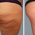 Natural Ways to Prevent Cellulite.