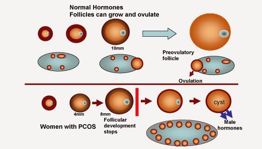 Cara Mengobati PCOS (PCOS Bisa Hamil) Cara Mengobati PCOS (PCOS Bisa Hamil)