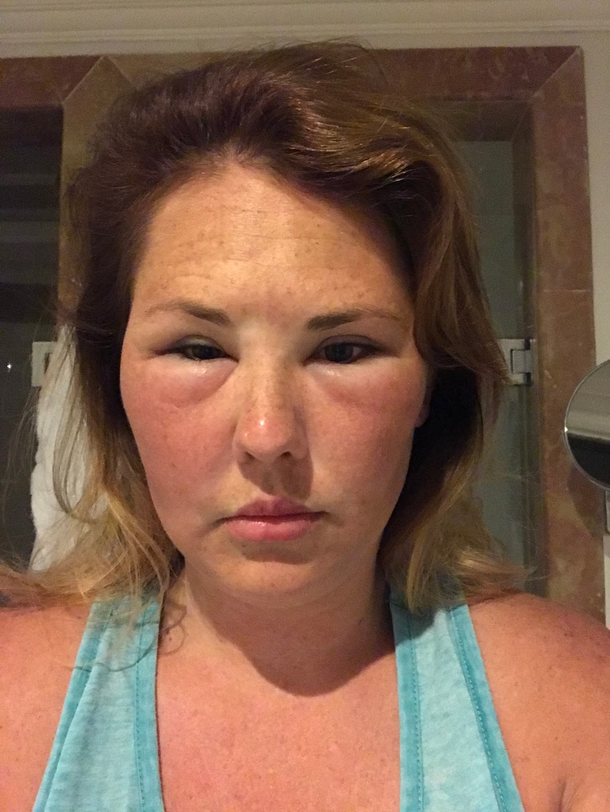 Sun Poisoning Skin Reactions