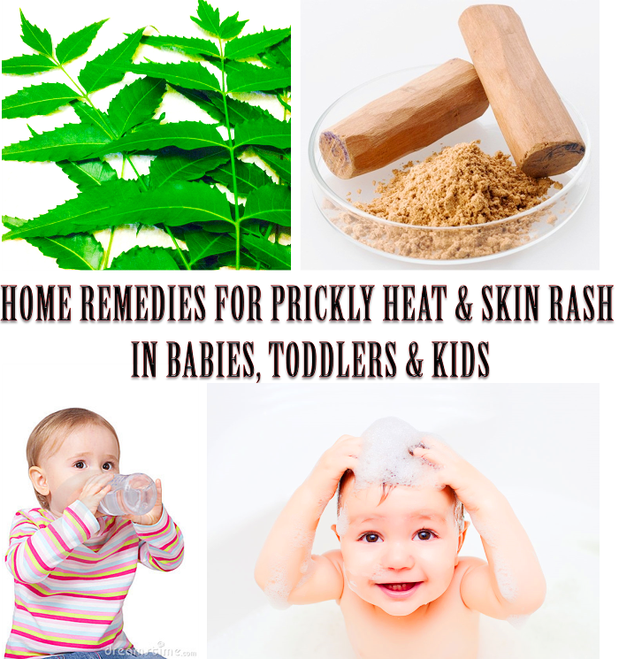 Home Remedies For Prickly Heat Rash On Babies Heat Rash Treatment For