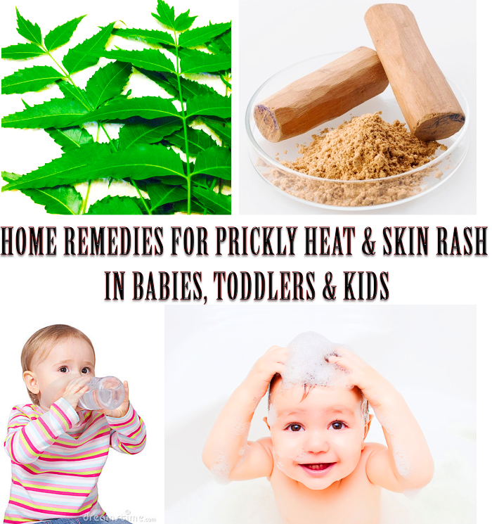 Home Remedies for Prickly Heat Rash on Babies Heat Rash Treatment for