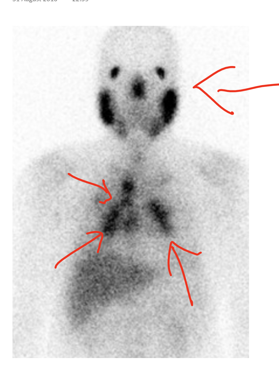 Sarcoidosis Gallium Scan Sumer's Radiology Blog