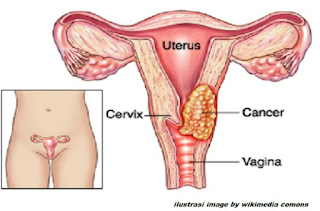 nyeri saat menstruasi nyeri saat menstruasi