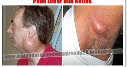 Obat Pembengkakan Kelenjar Getah Bening di Leher dan Ketiak yg TERBUKTI