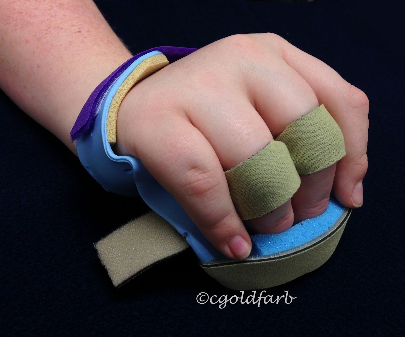Camptodactyly bent finger treatment with splinting Congenital Hand and Arm Differences