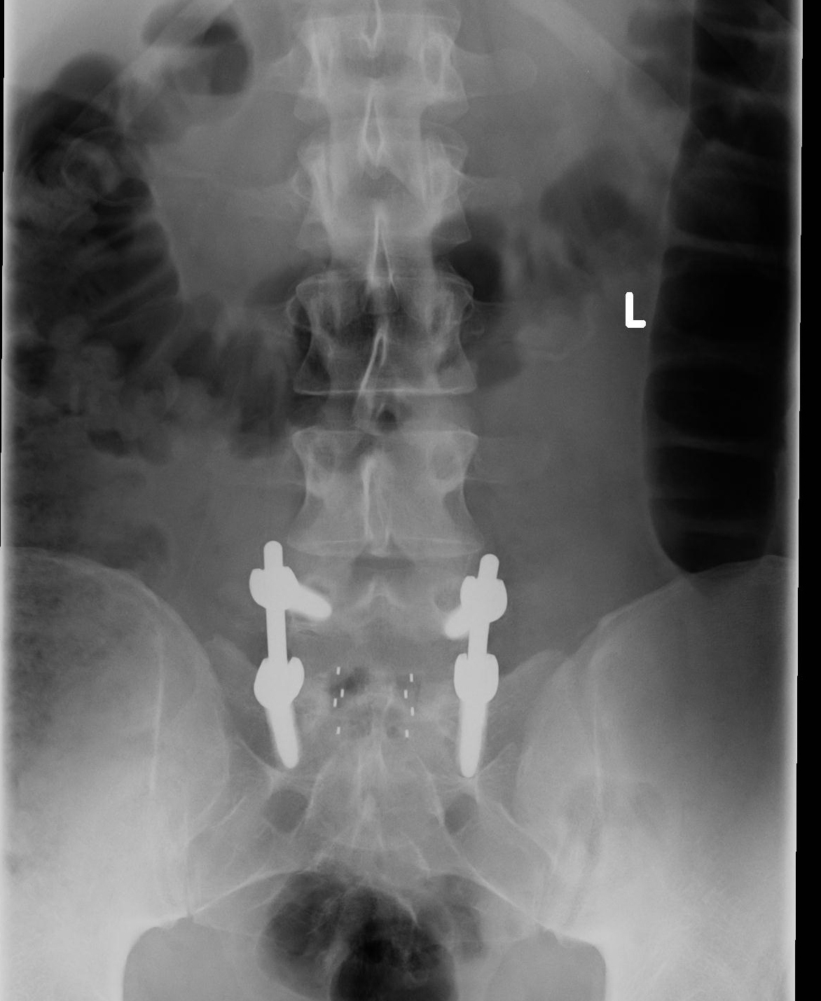 Excuse me...fuse me too!! My story of L5S1 spinal fusion