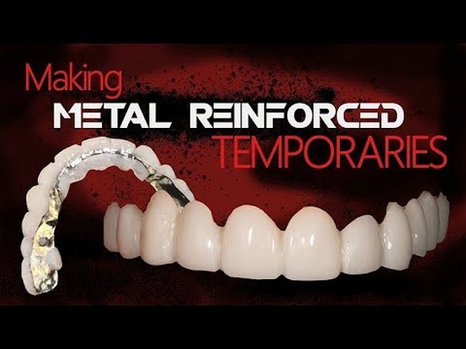 PROSTHODONTICS: Making Metal Reinforced Temporaries