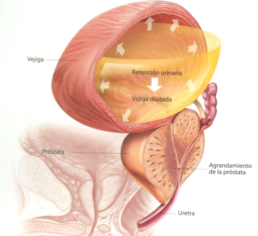 hiperplasia benigna de próstata cie 10)