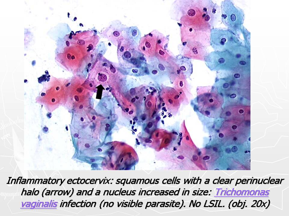 Lsil цитология форум