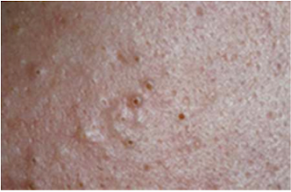 clogged pores and blackheads clogged pores and blackheads