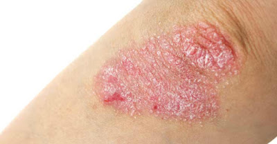 Eczema thể đồng tiền