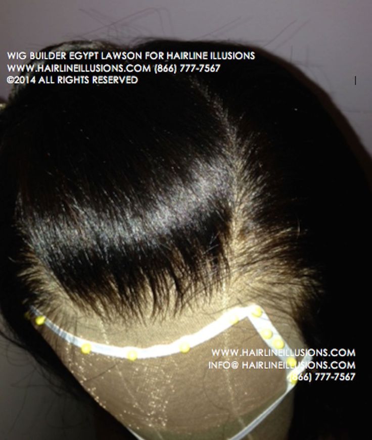 prosthesis cranial wigs lace wig cost illusions hairline covers care health united hair egypt medical hairstyles scalp uploaded user