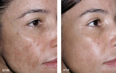 Cream Menyamarkan Noda Hitam Liyoskin Cream Menyamarkan Noda Hitam