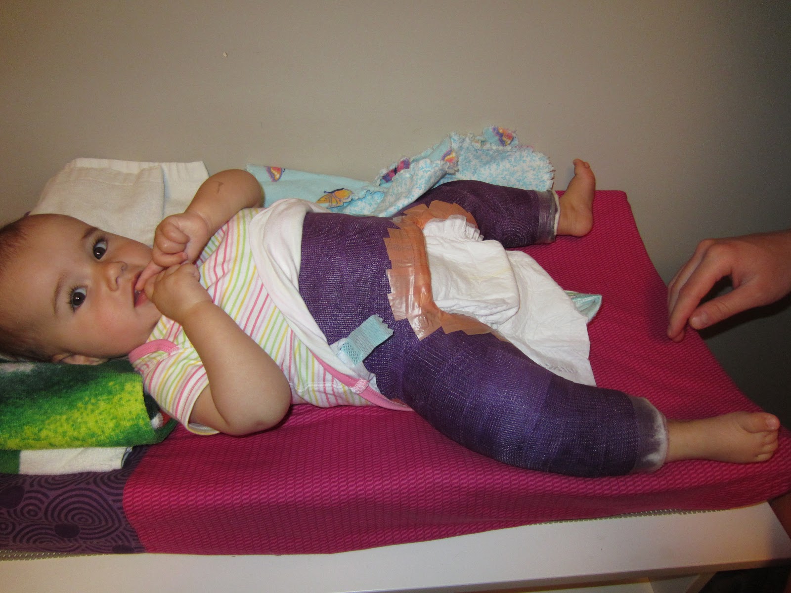 Mackenzie's Hip Adventures Diapering in the Spica Cast