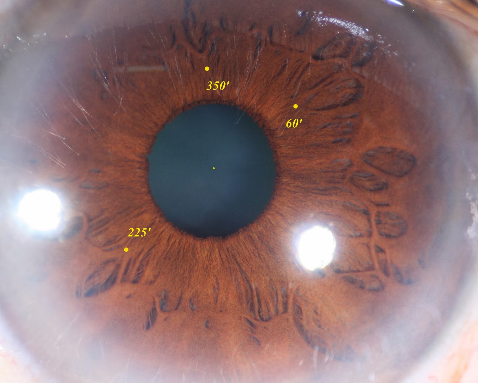 Modern & Multidimensional Iridology Squared, Distended & Local