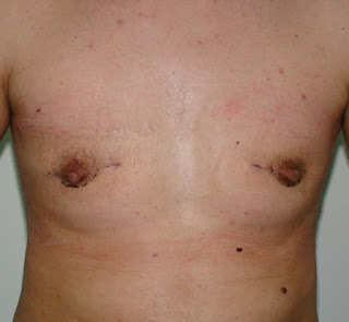 Outcome one month after surgery