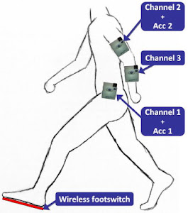 Evaluation of a wireless in-shoe sensor based on ZigBee used for drop foot stimulation