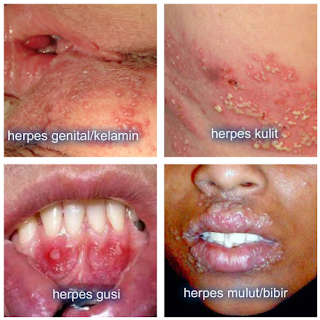 obat penyakit herpes | Cara Mengatasi Ambeien