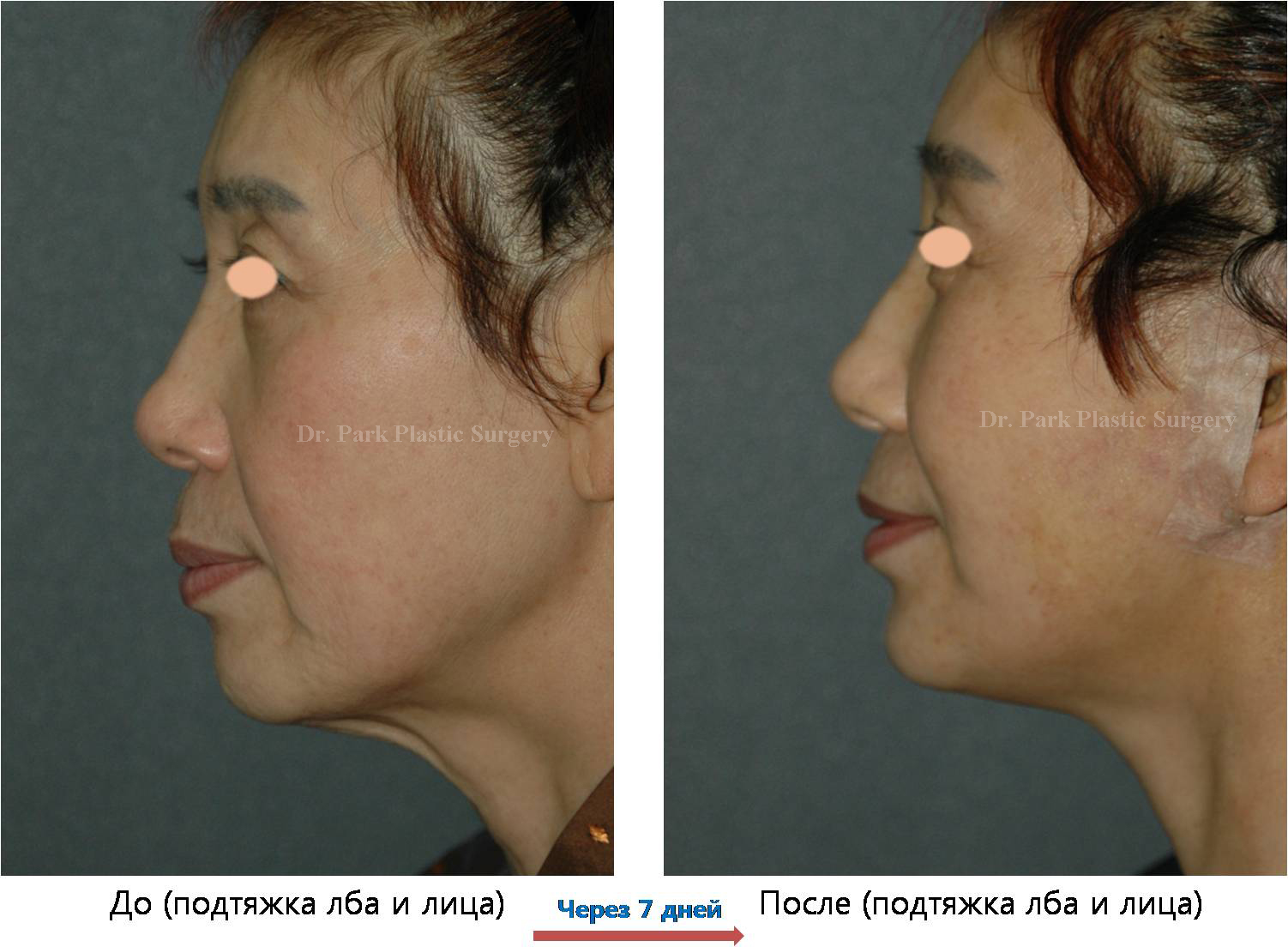 Bios clinic ворошкевич. липофилинг овала лица. последствия пластических операций в старости. европеизация азиатских век фото по дням. клиника пластической хирургии биос.